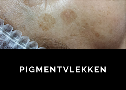 PIGMENTVLEKKEN