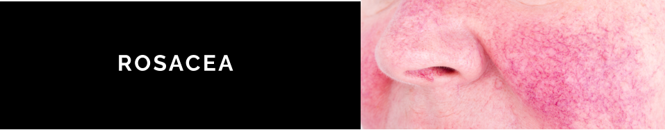 ROSACEA