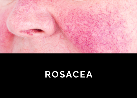 FIBROMEN STEELWRATJES ROSACEA