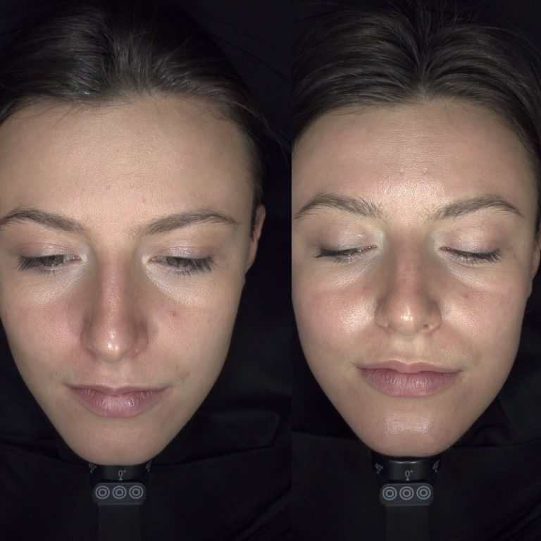 Resultaat direct na 1 NANOdermabrasie met Vitabrite peeling
