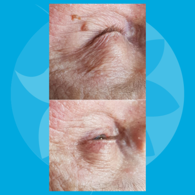 Behandeldoel: Verwijderen steelwratjes oog