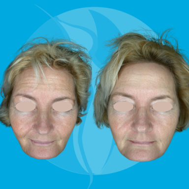 Behandeldoel: Algehele huidconditie verbeteren