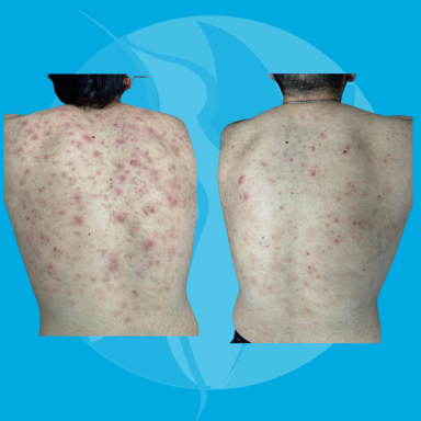 Behandeldoel: Acne rustiger krijgen rug