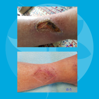 Lymfoedeem en open been